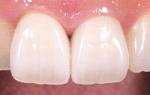 セラミッククラウン修復後